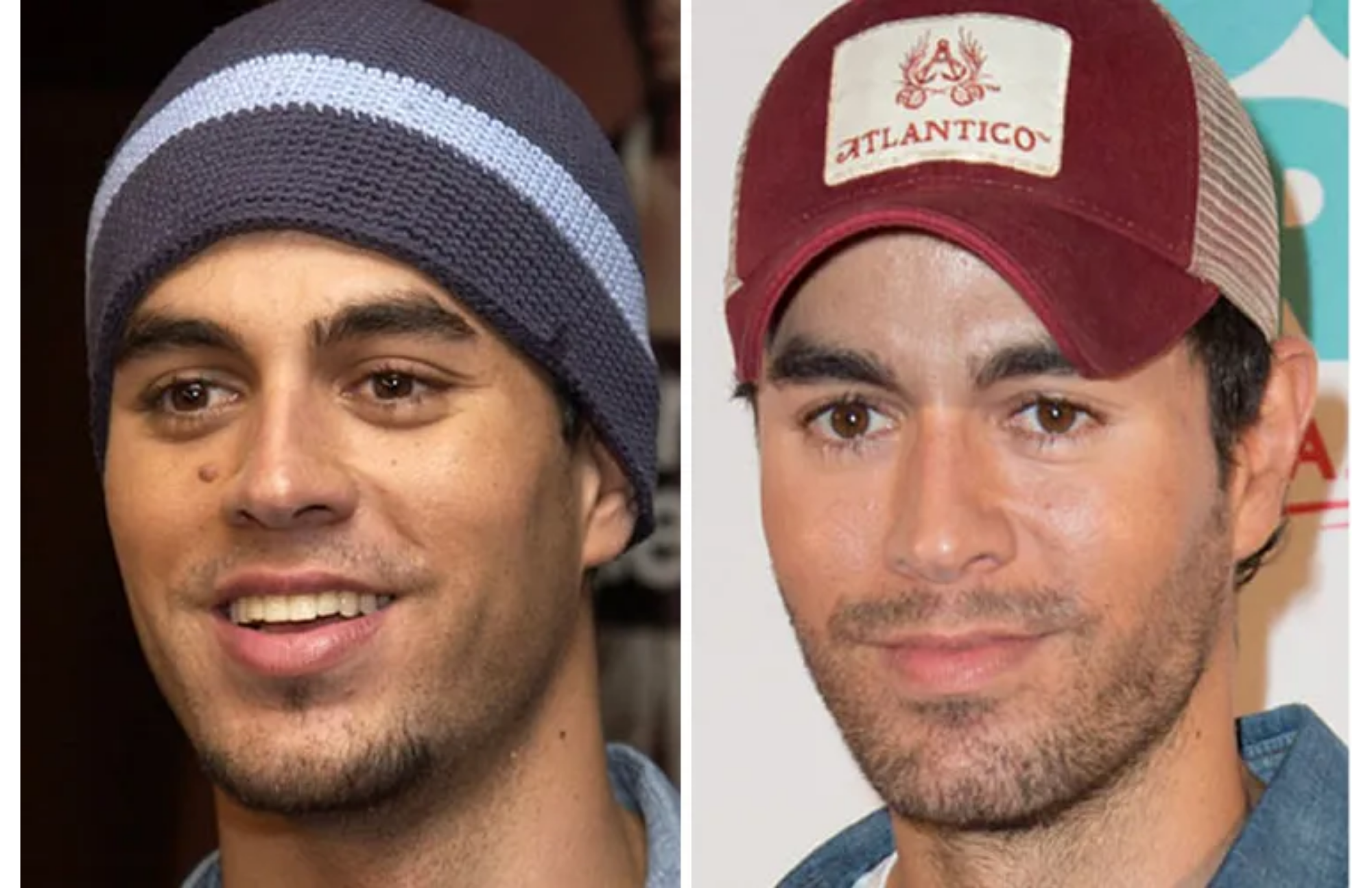 Enrique Iglesias mole before and after