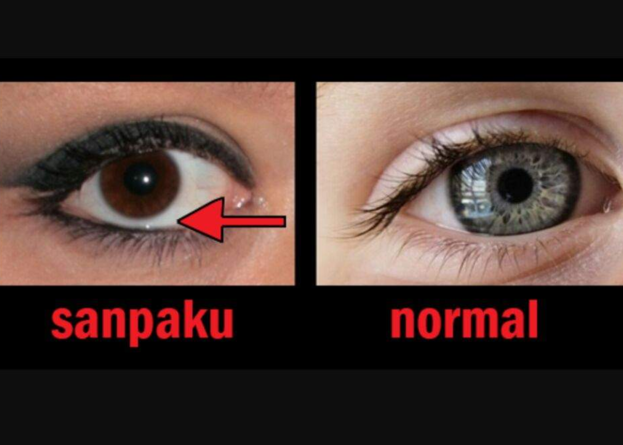 An arrow pointing from right to left depicts a normal eye, while a single eye on the left depicts a sanpaku